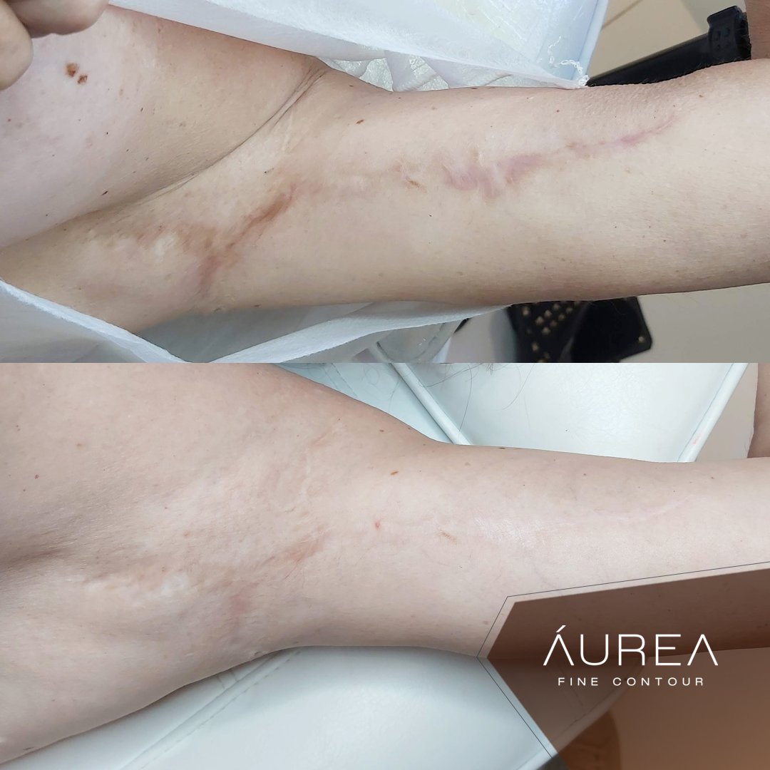 Resultado Protocolo Áurea Skin