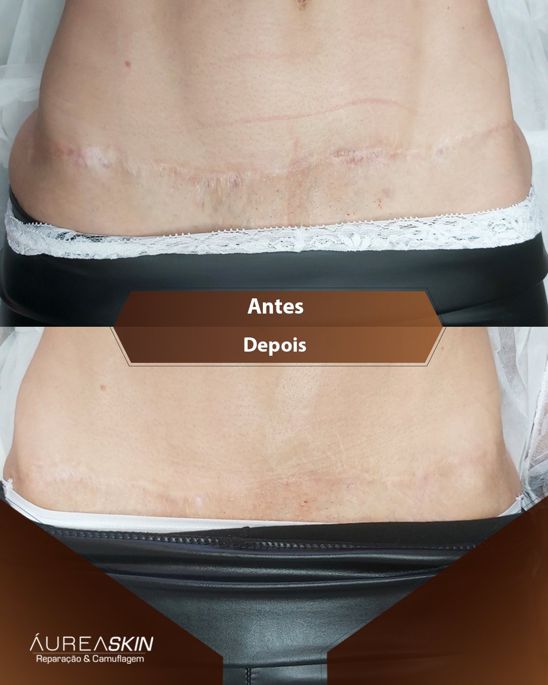 Resultado Protocolo Áurea Skin